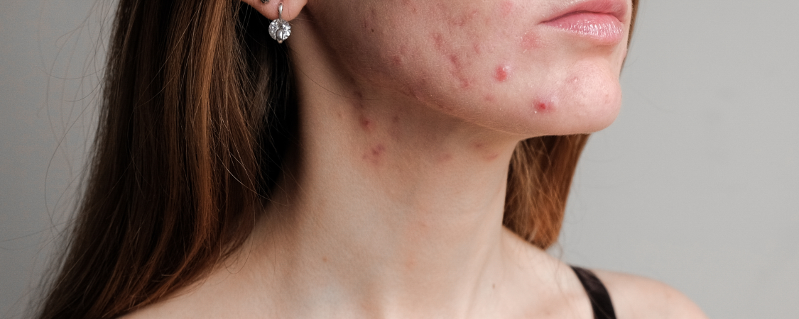 Understanding Adult Acne: Causes and Prevention Tips - Southern ...